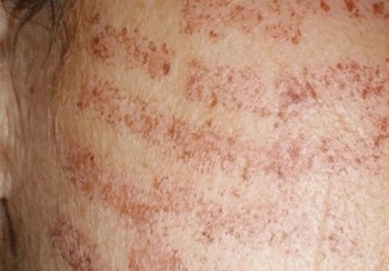 عوارض لیزر موهای زائد چیست و چگونه می‌توان آن‌ها را کاهش داد؟