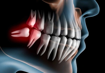 کشیدن دندان عقل