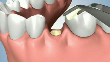 لق شدن دندان دائمی3