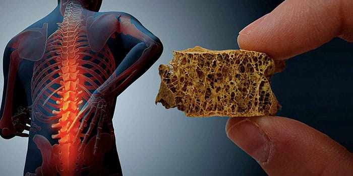 پوکی استخوان4