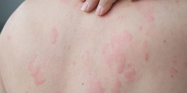 عوارض لیزر موهای زائد1