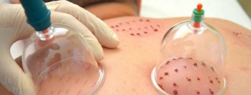 مراقبت‌ های قبل و بعد از حجامت چیست؟6