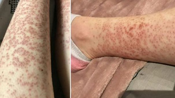 عوارض لیزر موهای زائد2