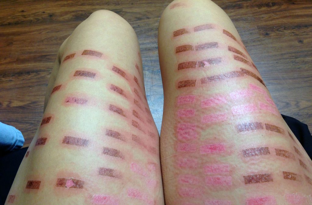 عوارض لیزر موهای زائد3