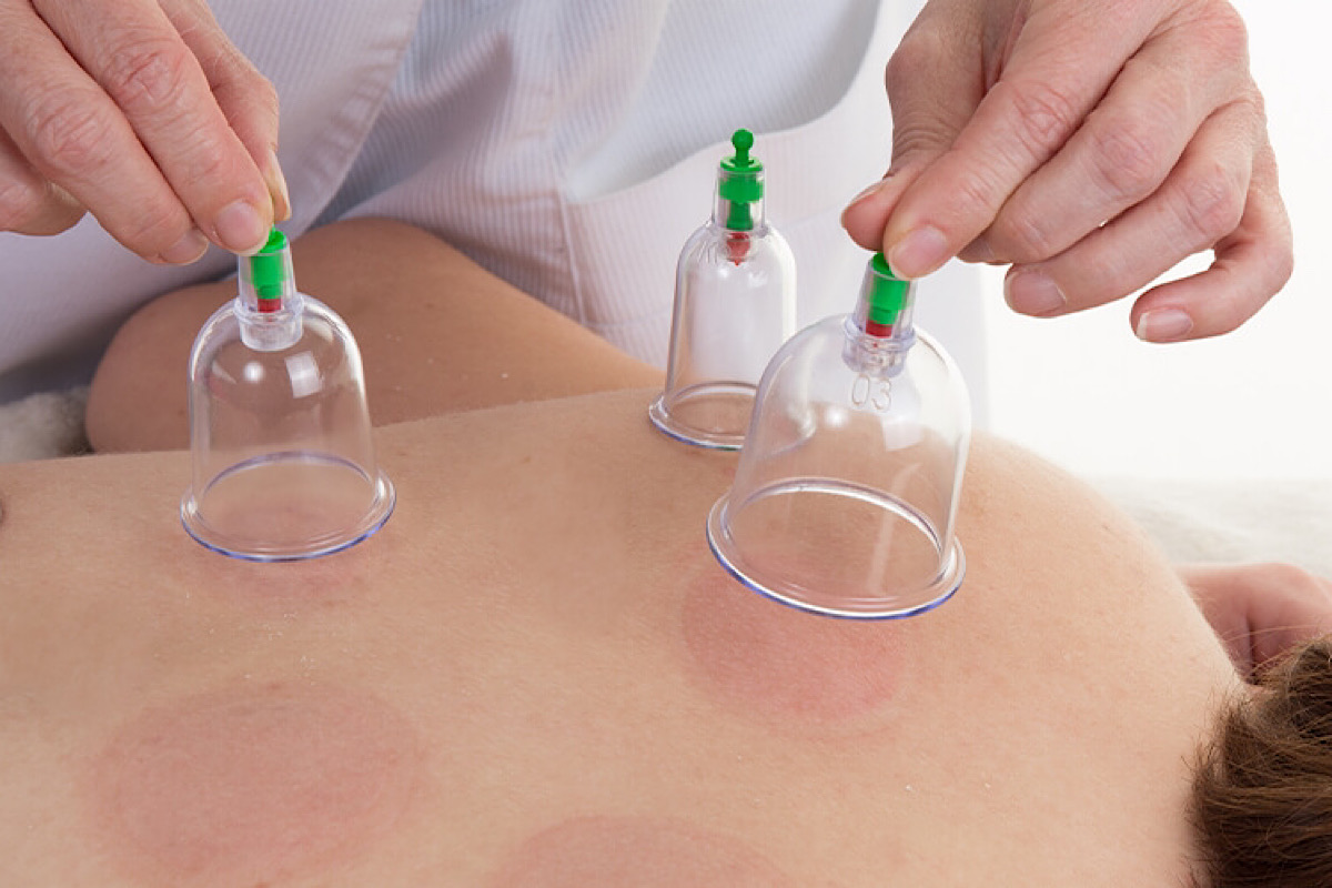 مراقبت‌ های قبل و بعد از حجامت چیست؟2