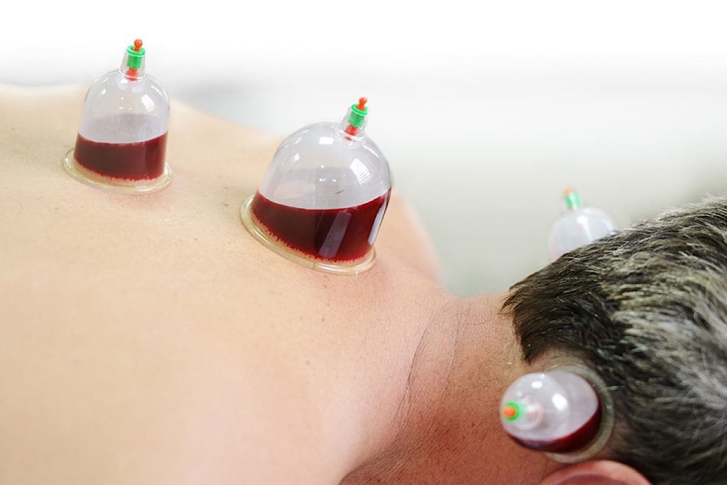 مراقبت‌ های قبل و بعد از حجامت چیست؟